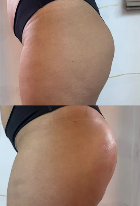 BUNDA 1